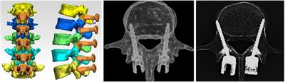 Feasibility and improvement of a three-dimensional printed navigation template for modified cortical bone trajectory screw placement in the lumbar spine